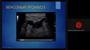 Ультразвуковая диагностика венозных тромбозов и ПТФС  Ерошенко О Л