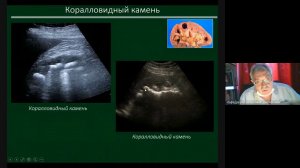 УЗД заболеваний почек  Часть 2  зав каф проф Неласов Н Ю