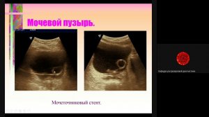 УЗ диагностика заболеваний мочевого пузыря и мочеточников