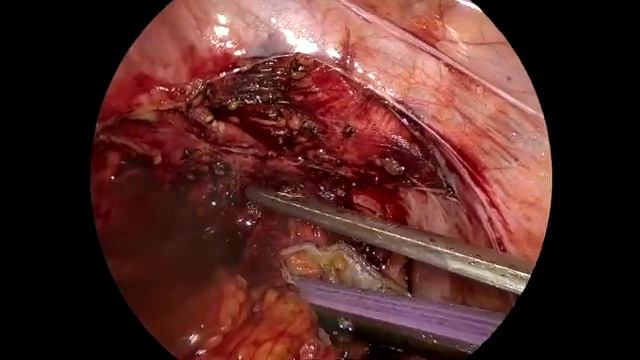 Laparoscopic TME after neoadjuvant therapy with left ureter injury-repair смотреть онлайн