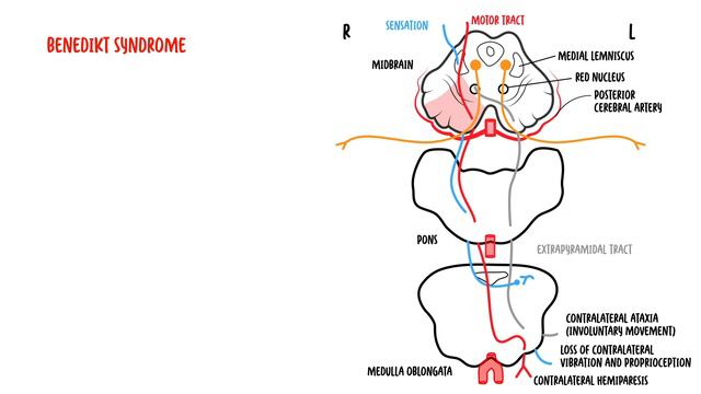 Midbrain Syndromes - Weber’s Syndrome, Benedikt’s Syndrome and Parinaud Syndrome. смотреть онлайн