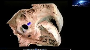 Эхокардиография при ВПС у взрослых Неласов Н Ю