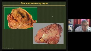 УЗД заболеваний ЖВП 2  Неласов Н Ю