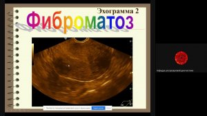 Ультразвуковая диагностика миомы матки Паленый А И