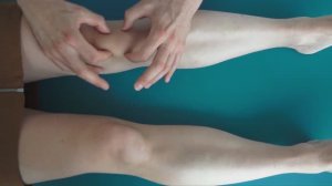 #Пателлофеморальный #артроз. #Диагностика_артроза