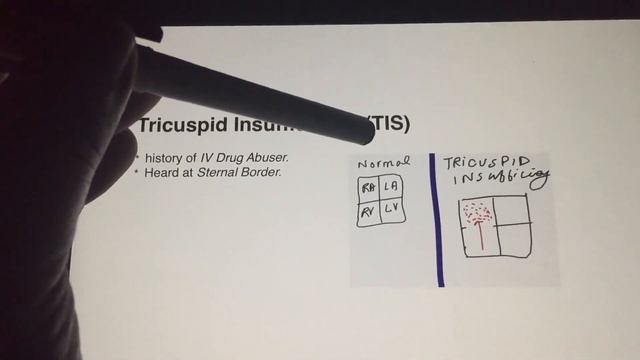 Heart Murmurs | Made Ridiculously Simple with a Mnemonic | USMLE | Cardiology смотреть онлайн