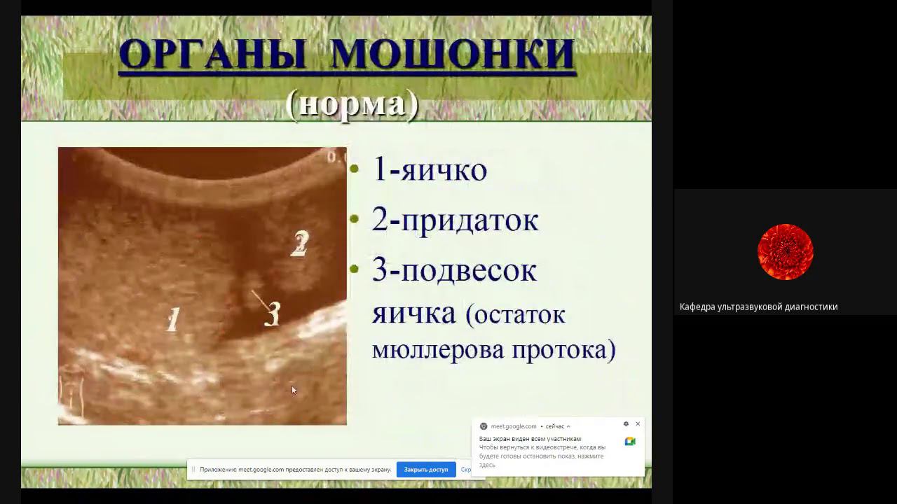 УЗД заболеваний органов мошонки  Паленый А И