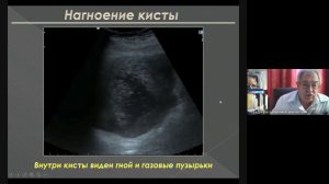 УЗД заболеваний печени 2  Неласов Н Ю