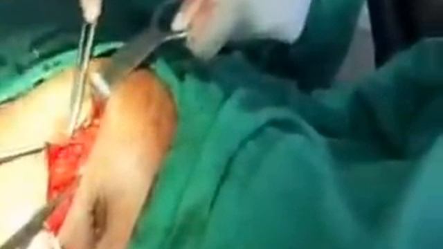 A Large Peri-umbilical Hernia Surgery смотреть онлайн