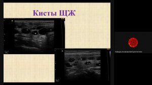 Лекция  УЗИ щитовидной железы Гусельникова М Р