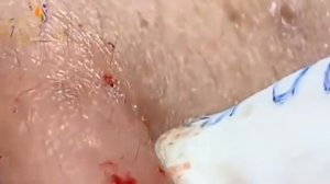 Hien Nguyen Acne #114 Relaxing Blackheads Removal