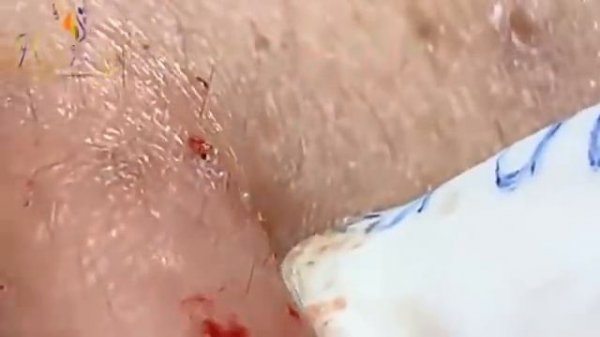 Hien Nguyen Acne #114 Relaxing Blackheads Removal