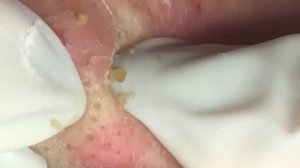 🔥 Pimple Popping 2020 Video| Super blackheads removal in nose| Blackheads extraction| Acne removal