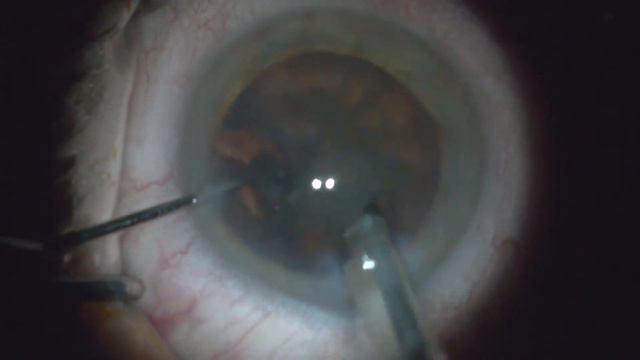 Standard Cataract Surgery with Stellaris Elite phacoemulsification by Steven Kane, MD смотреть онлайн
