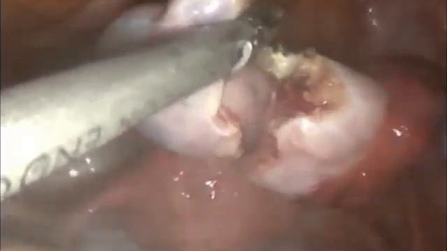 Teratoma extraído por laparoscopia Dr. Enrique Rivero Weber смотреть онлайн