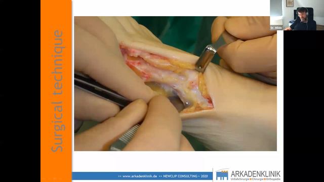 Newclip Faculty Live - Plantar Lapidus Arthrodesis: 10 years of hindsight - Dr Christoph H. Wilde смотреть онлайн