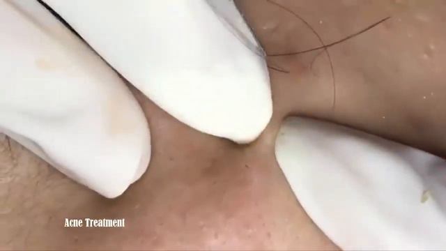 How To Get Rid Of Blackheads & Whiteheads Easy   Acne Treatment Part 7