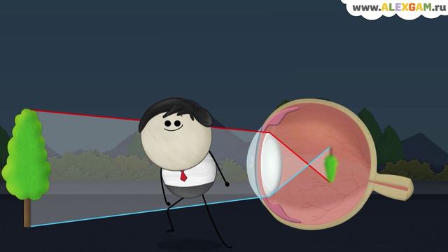 Что вызывает близорукость? смотреть онлайн