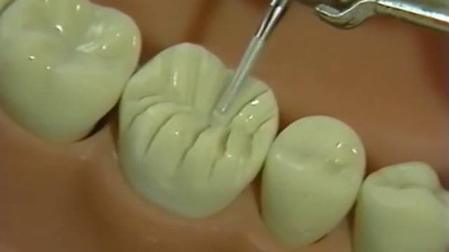 Complete Cast Crown Prep - Part 1 смотреть онлайн