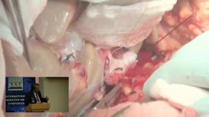 Пересадка печени у взрослых. Вальдо Консепсьон