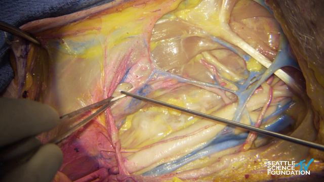 Carotid Endartectomy - Anatomical Landmarks - Matias Costa, M.D. смотреть онлайн