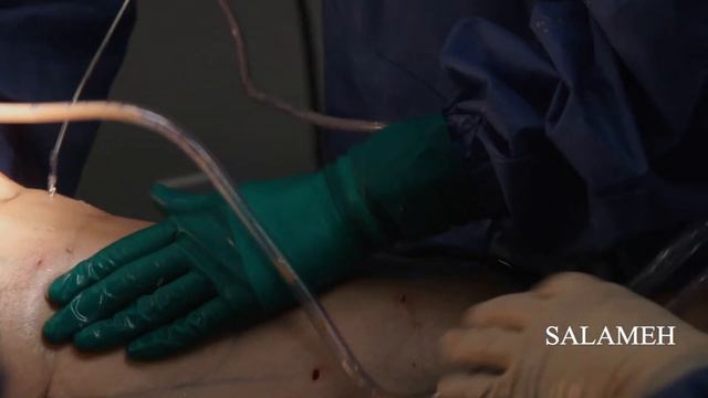 Lipedema Fat Removal in Lower Legs | the procedure part 2 | Salameh смотреть онлайн