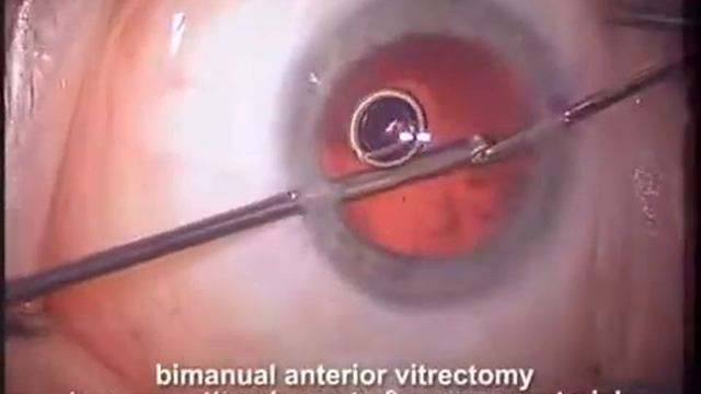 Anterior Vitrectomy Tips смотреть онлайн