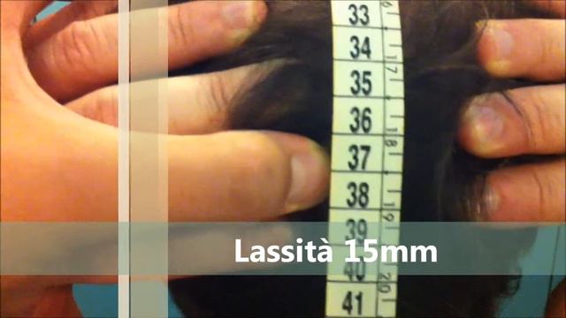 O.T. Metodo D'Ambra trattamento per la lassità / pre8mm post 15mm; Pz:9 смотреть онлайн