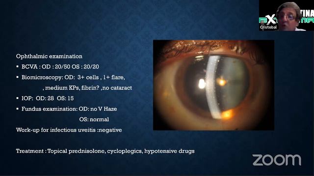 Uveitis Anterior e Intermedia смотреть онлайн