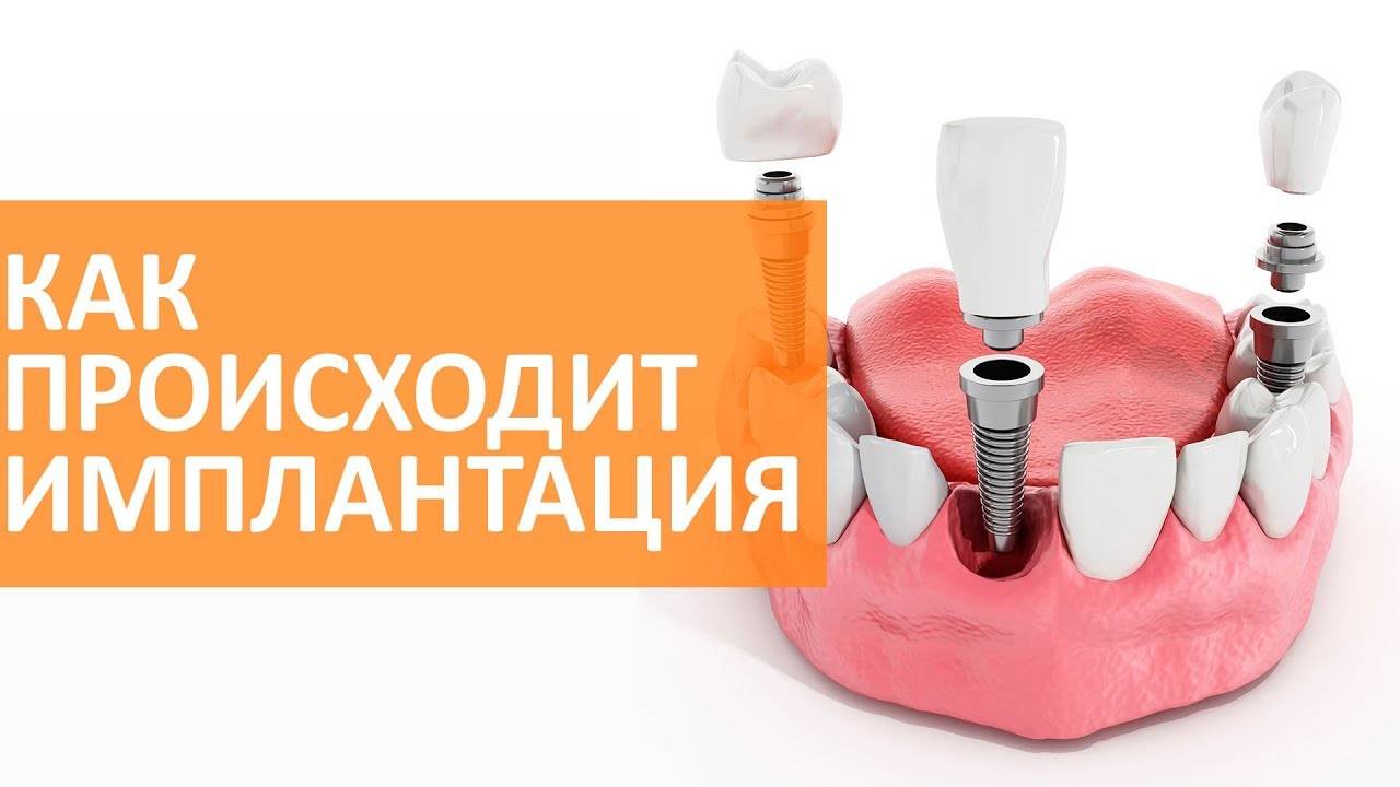Имплантация зубов: основные этапы смотреть онлайн