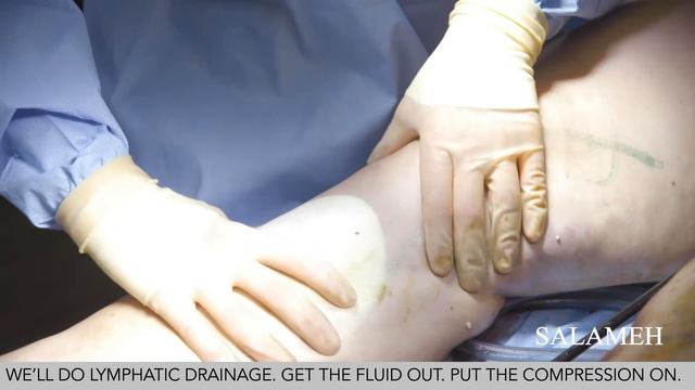 Lipedema Surgery With Liposuction Part 3 | Salameh