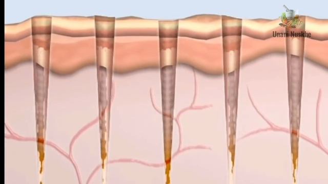 पिम्पल से हुए गड्ढे कैसे दूर करें | chicken pox ke gadde mitane ke upay смотреть онлайн