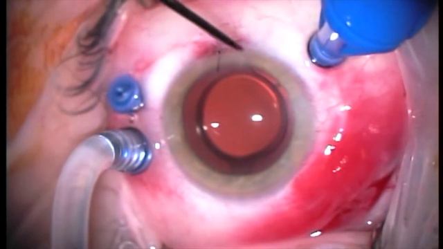 Phacovitrectomy for retinal tears with local retinal detachment смотреть онлайн