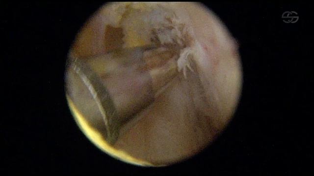 SUTURA DE MENISCO INTERNO смотреть онлайн