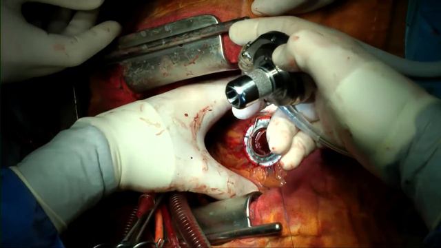 LVAD implant. Left ventricular assist device implantation смотреть онлайн