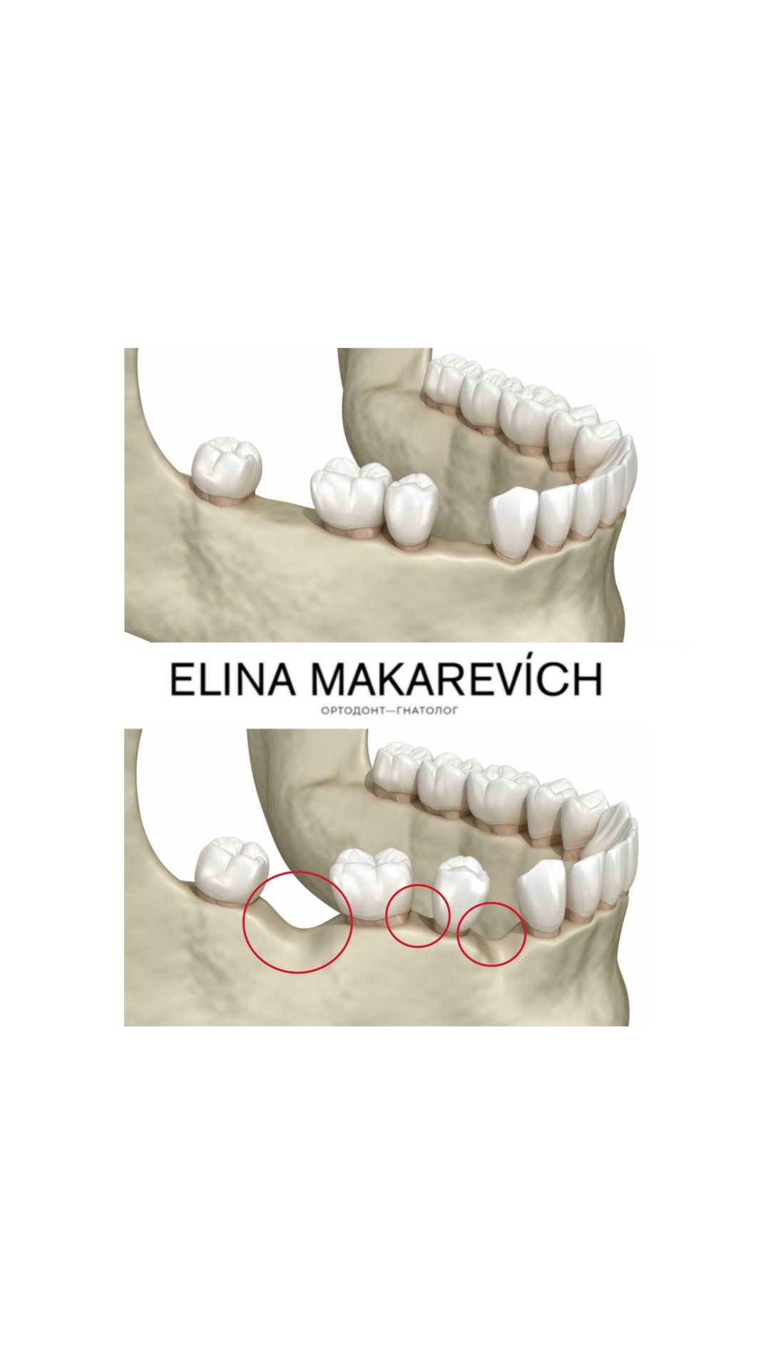Какие изменения произойдут в полости рта после потери зуба?