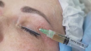 Мастер-класс «Комбинированная терапия COLLOST micro и PRP в одном шприце»