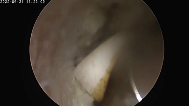 #endoscopicdairies#spreadtheflame#howdoidoit#. Extraforaminal disc at L5/s1 смотреть онлайн