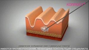 Как работает гель КОЛЛОСТ®