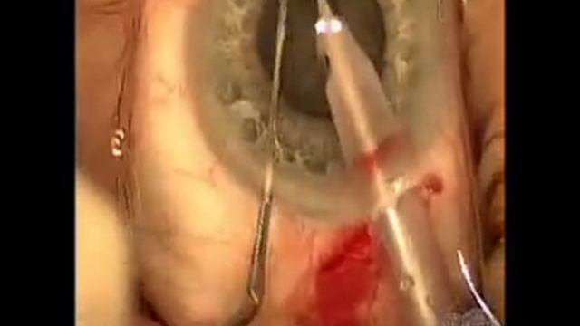 Cataract Surgery with Akreos IOL смотреть онлайн
