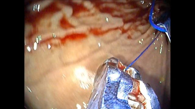 Endoscopic Sleeve Gastroplasty Apollo SX Single Channel First Experience