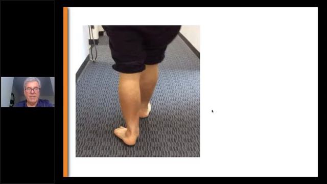 Complex Foot & Ankle Reconstruction Lecture Series Use of AFO Bracing for Complex Foot and Ankle C смотреть онлайн