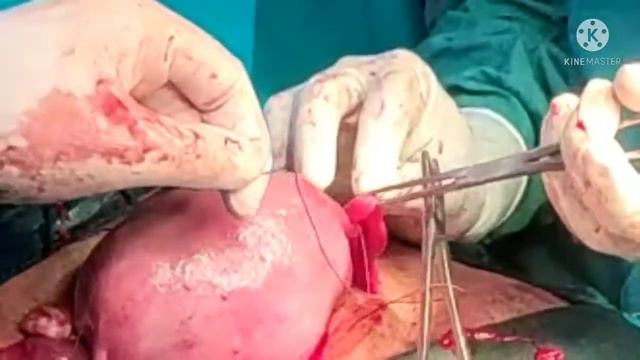 Tubal ligation after caesarean, pomeroy technique. смотреть онлайн