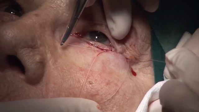 Entropion Correction