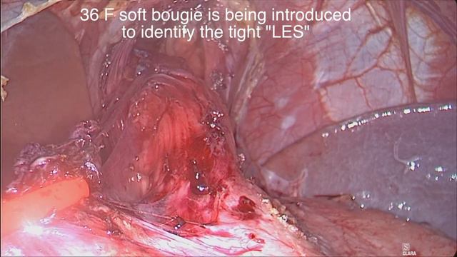 Laparoscopic Heller's myotomy for achalasia. "Uncut", by: Dr. Yerdel смотреть онлайн
