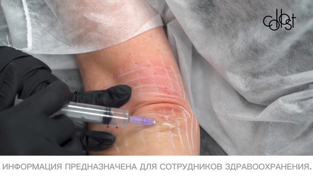 МАСТЕР-КЛАСС «Коррекция возрастных изменений области локтей с помощью COLLOST® Micro»