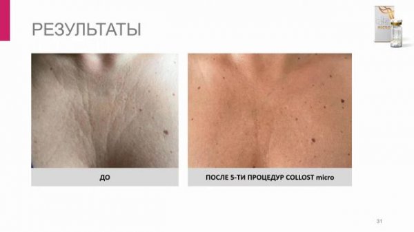 ВЕБИНАР: COLLOST® micro