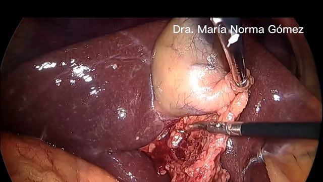 COLECISTECTOMÍA SEGURA. DESDE COLOCACIÓN DE TRÓCARES.DRA NORMA GÓMEZ HERRERA смотреть онлайн