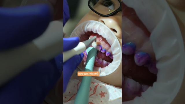 Как проходит детская профессиональная гигиена смотреть онлайн