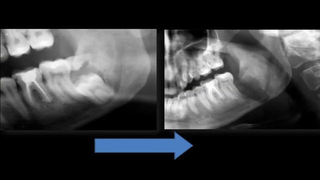 Biostimolazione tessutale: dall'estrazione dentale al posizionamento implantare смотреть онлайн
